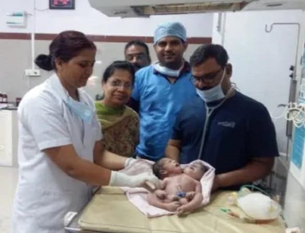 Inde: une femme donne naissance à des «jumeaux siamois rares»