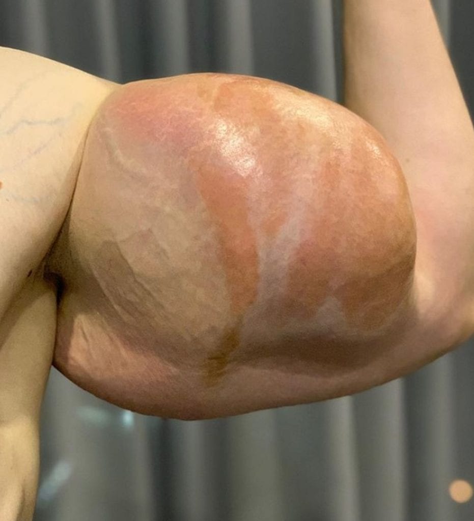 MMA : ce bodybuilder de 23 ans subit une intervention chirurgicale pour retirer une substance de ses biceps (photos)