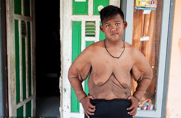 Arya Permana : découvrez comment l’enfant le plus gros du monde a perdu plus de la moitié de son poids (photos)