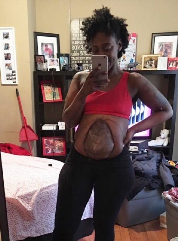 Une Américaine forcée de vivre avec les intestins hors de son ventre après une fusillade: Photos